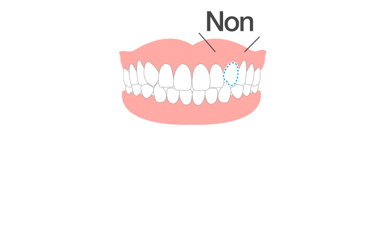 先天性欠損歯